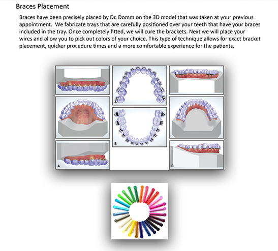 braces instructions