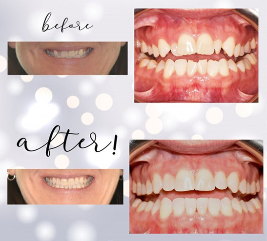 invisalign for adults